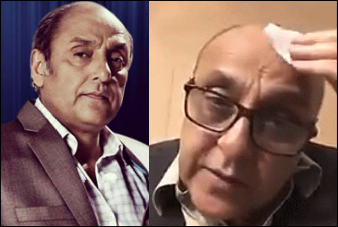 Sajid Hasan hair transplant